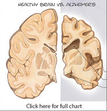 Alzheimer's chart