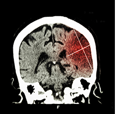 Brain scan of stroke